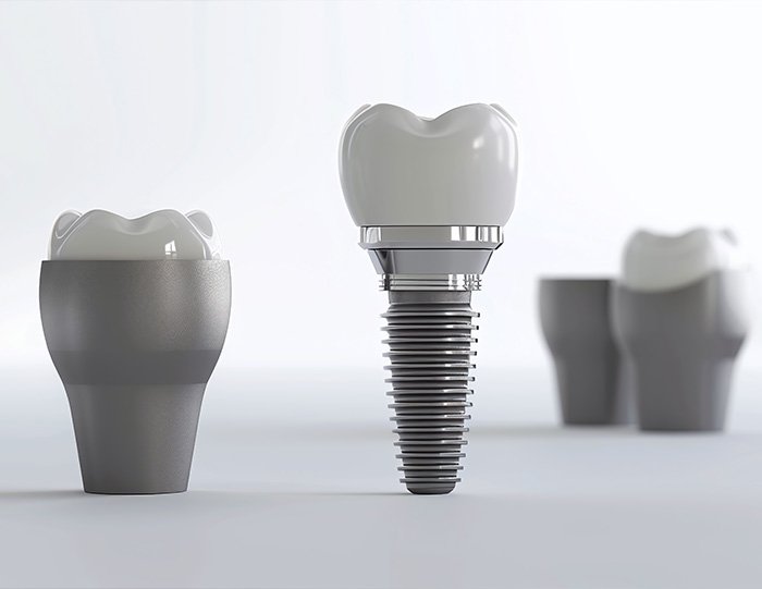 Implant Tedavisi
